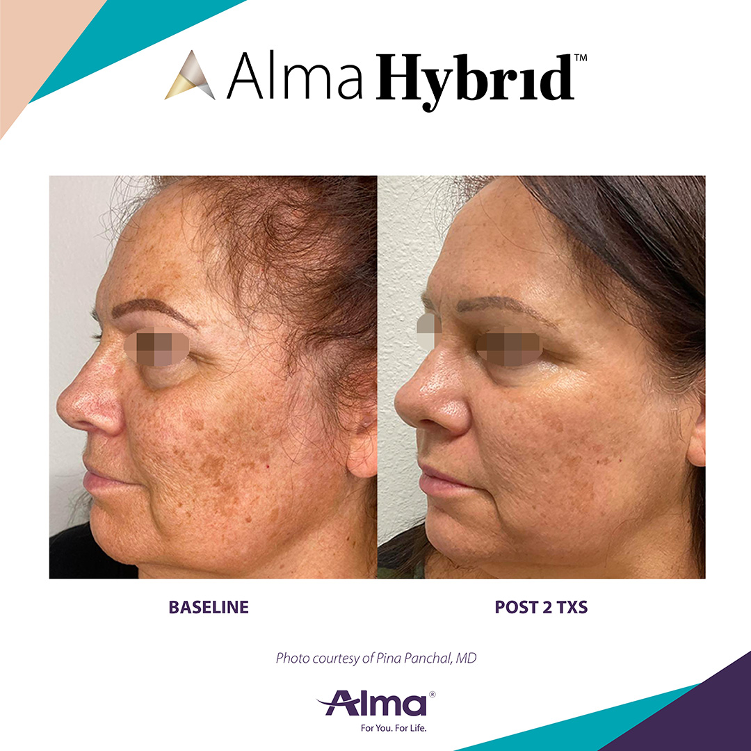 Before and After Image: Alma Hybrid - left-front-oblique