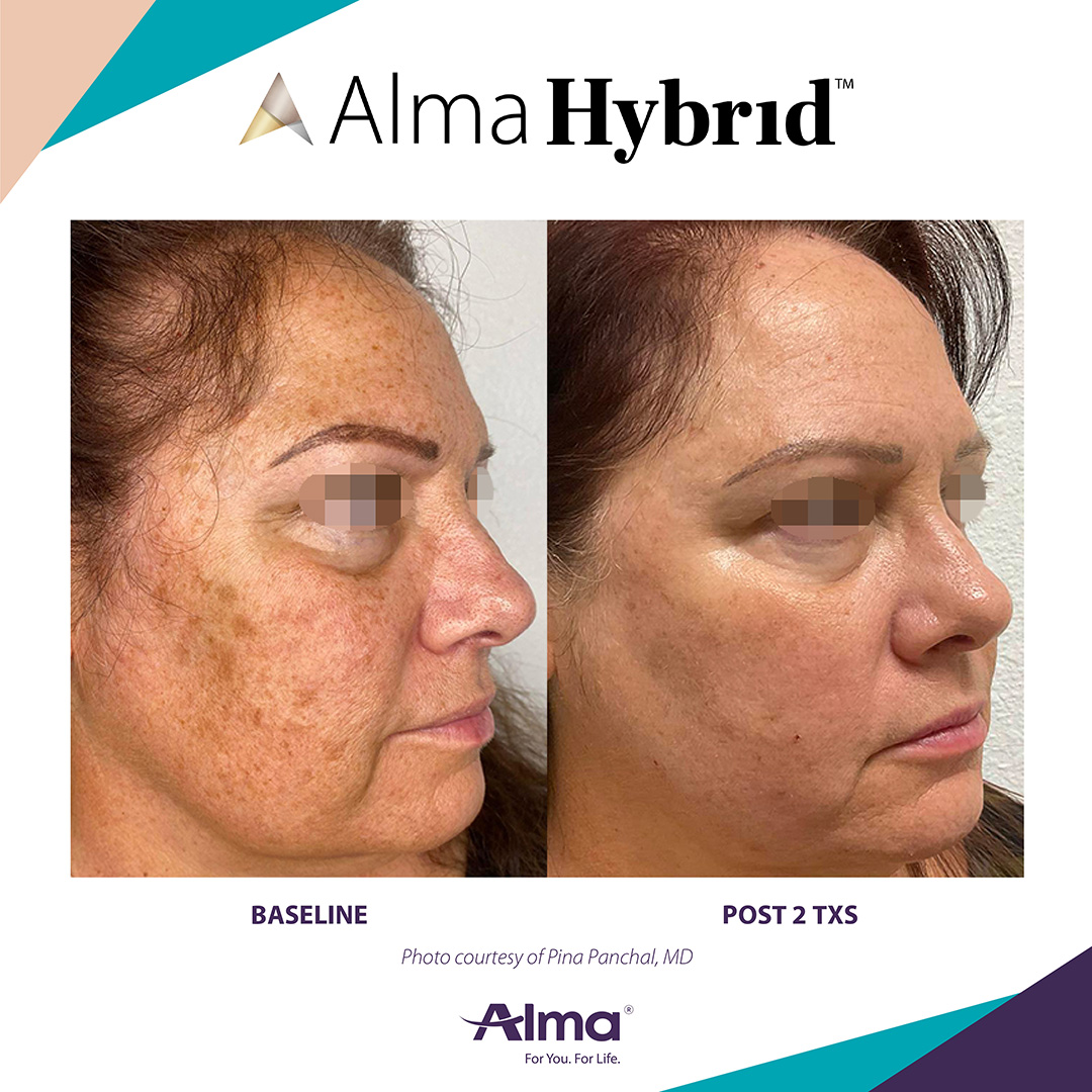 Before and After Image: Alma Hybrid - right-front-oblique