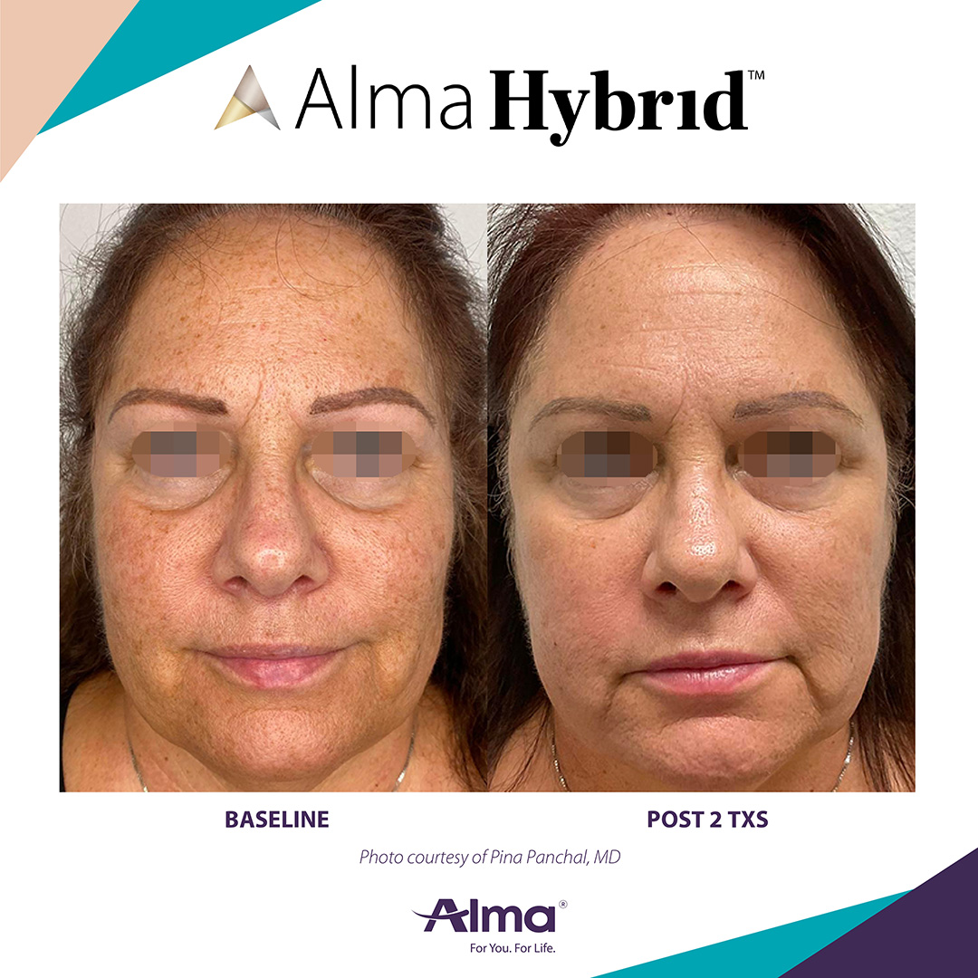 Before and After Image: Alma Hybrid - front