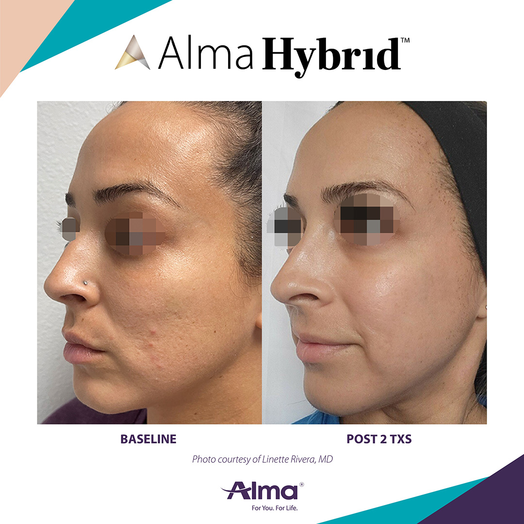 Before and After Image: Alma Hybrid - left-front-oblique