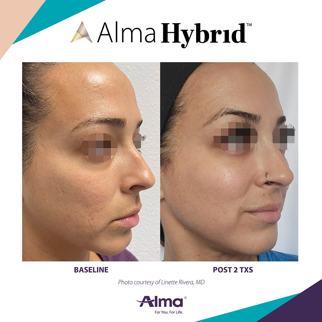 Before and After Image: Alma Hybrid - right-front-oblique