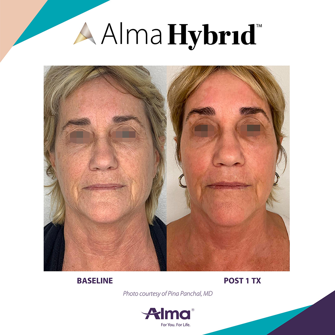 Before and After Image: Alma Hybrid - front