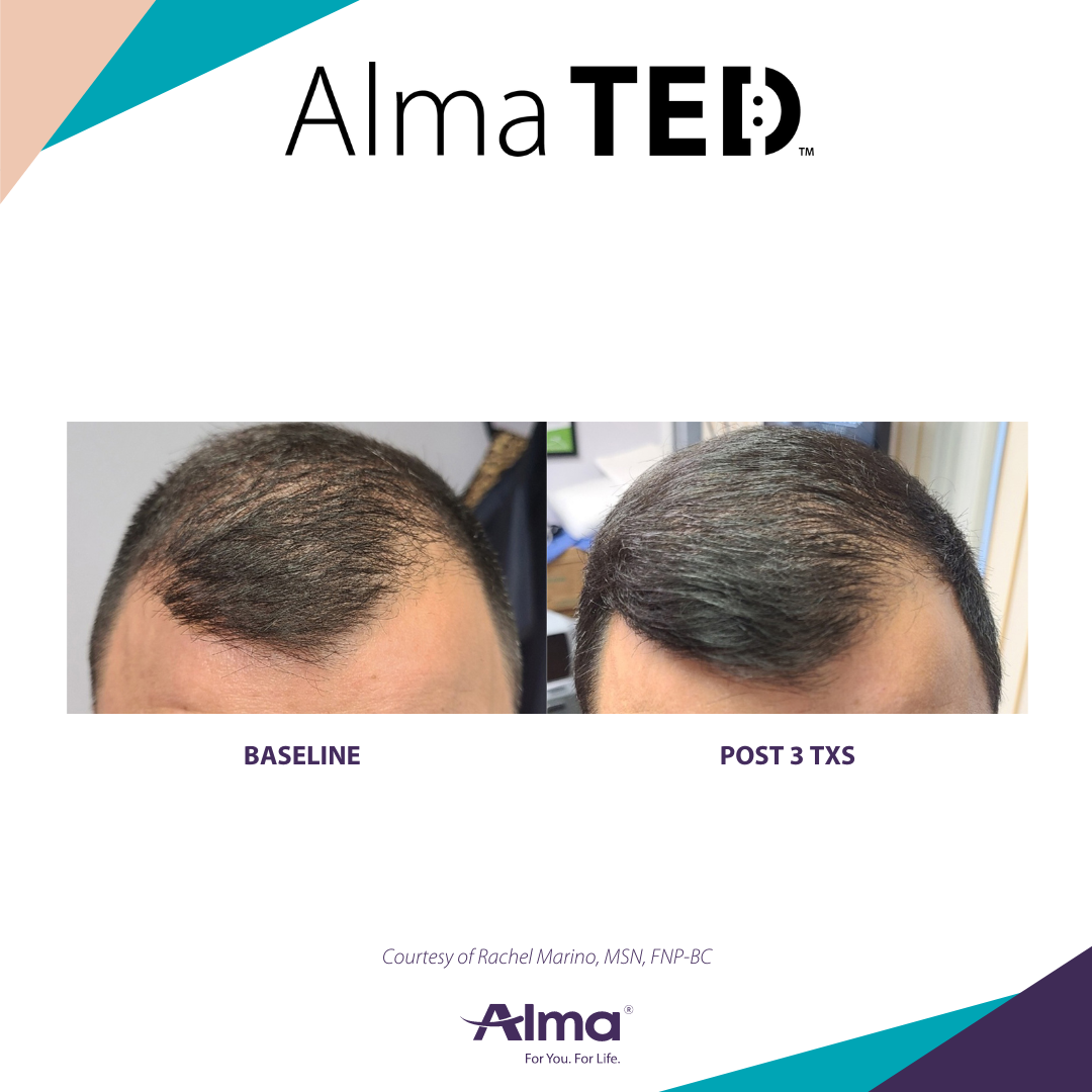 Before and After Image: Alma TED - front