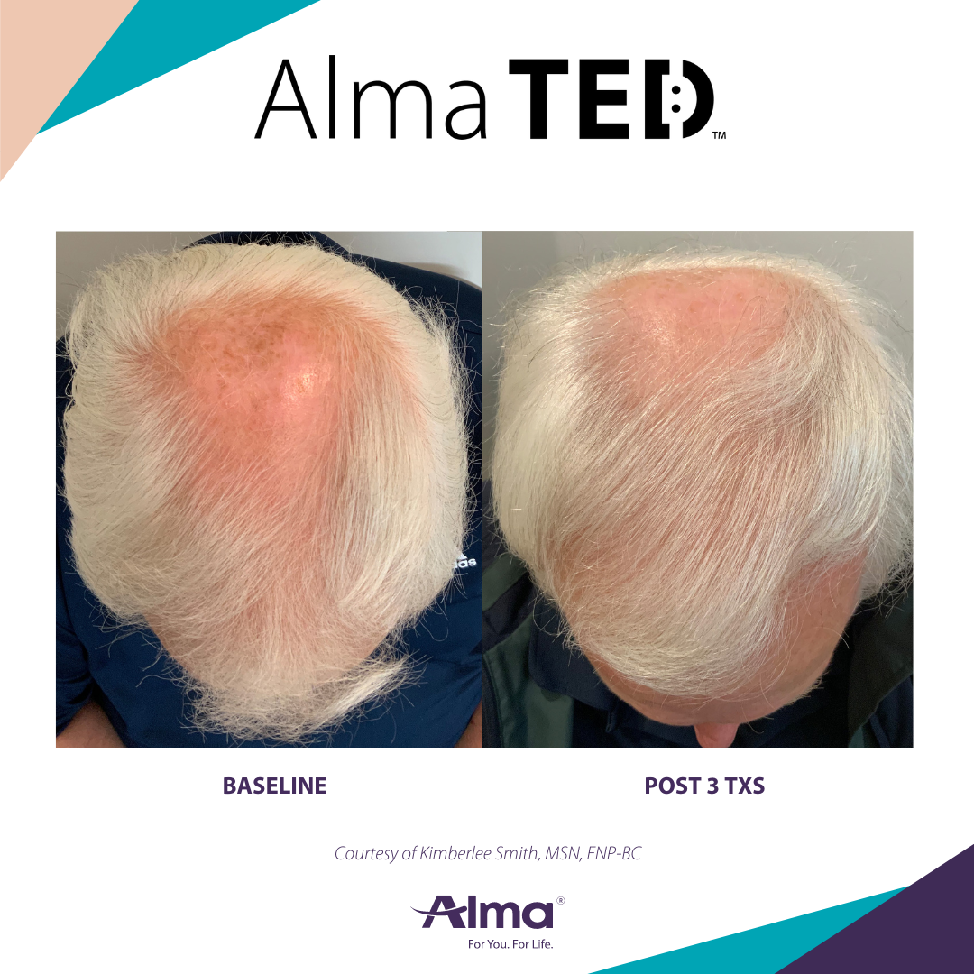 Before and After Image: Alma TED - front