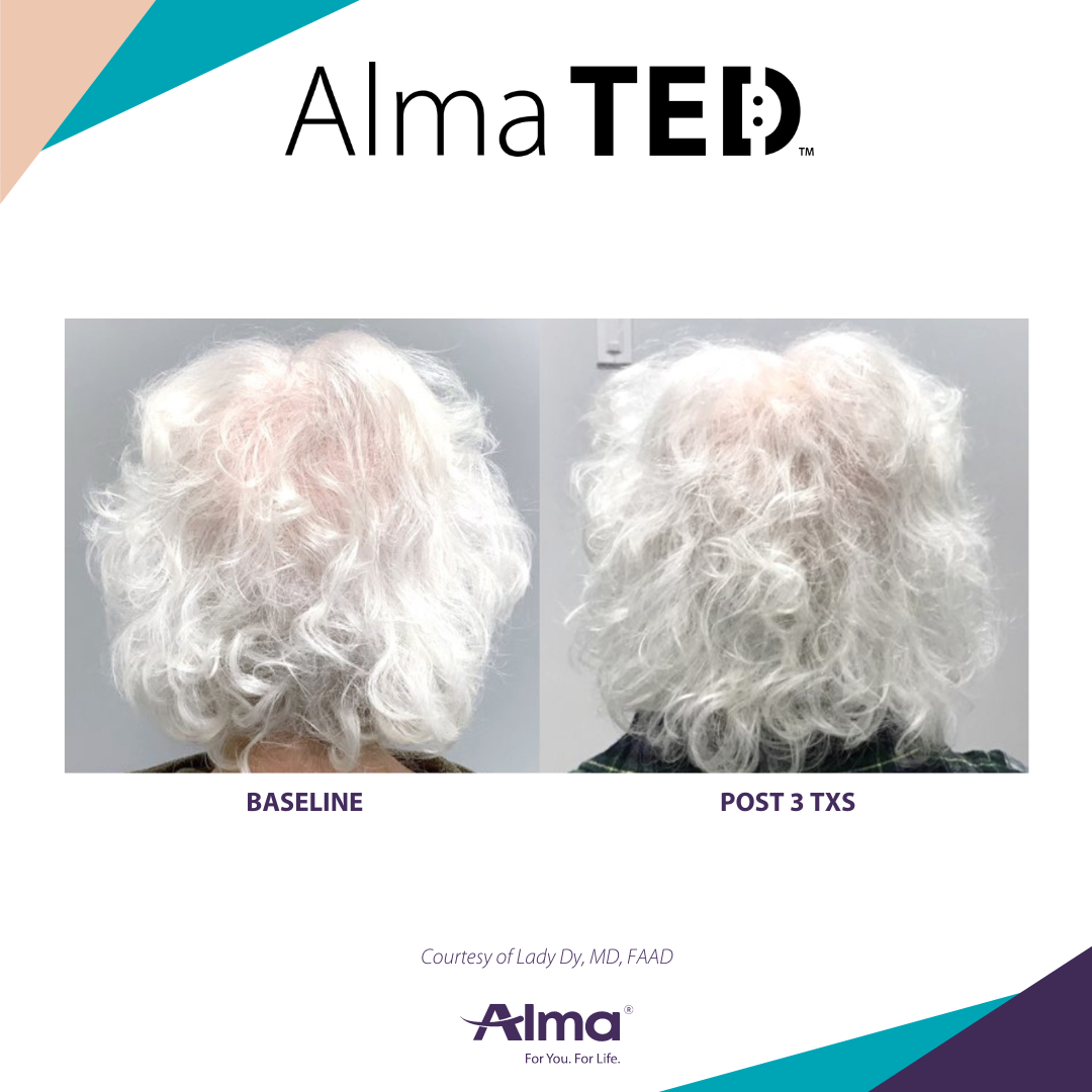 Before and After Image: Alma TED - back