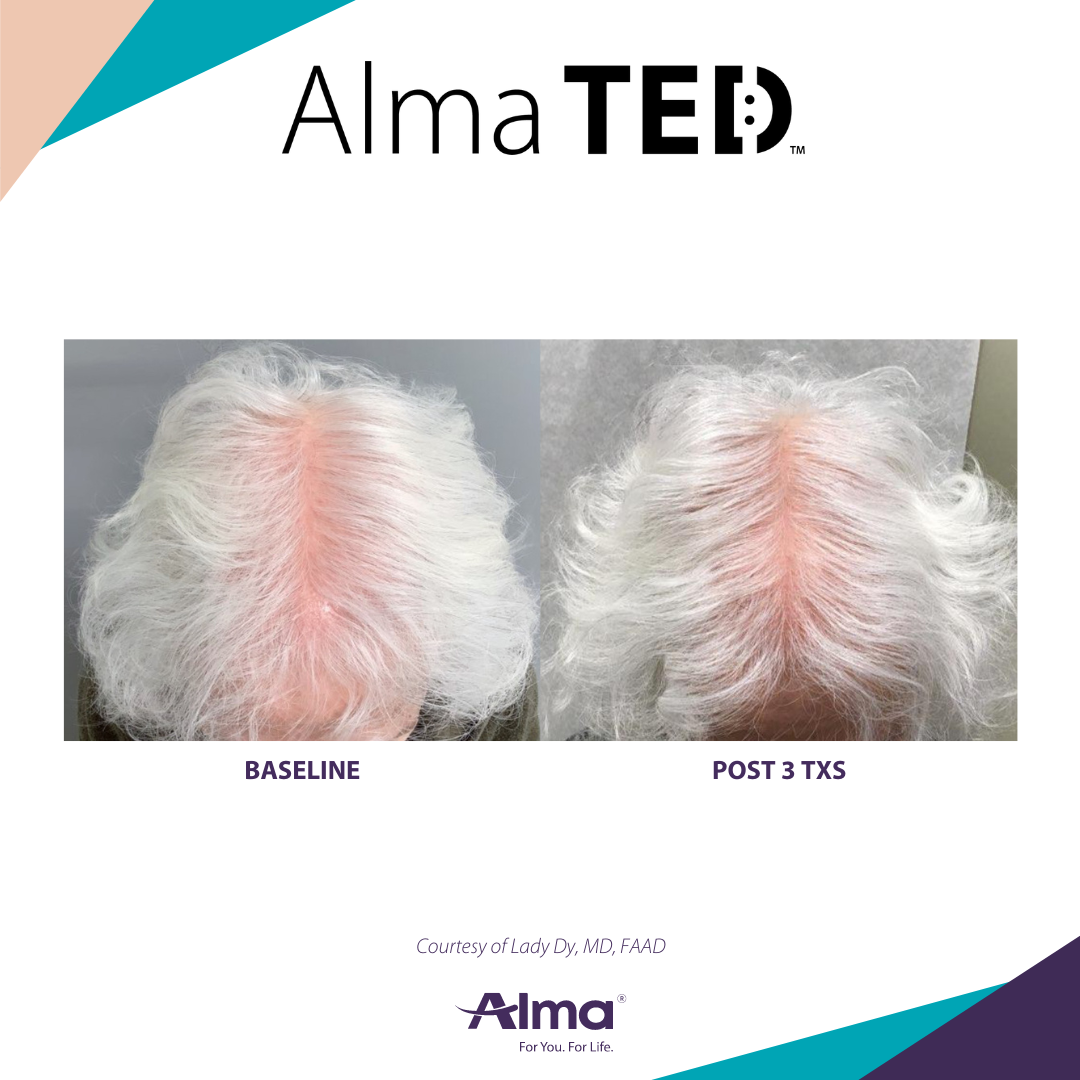 Before and After Image: Alma TED - front