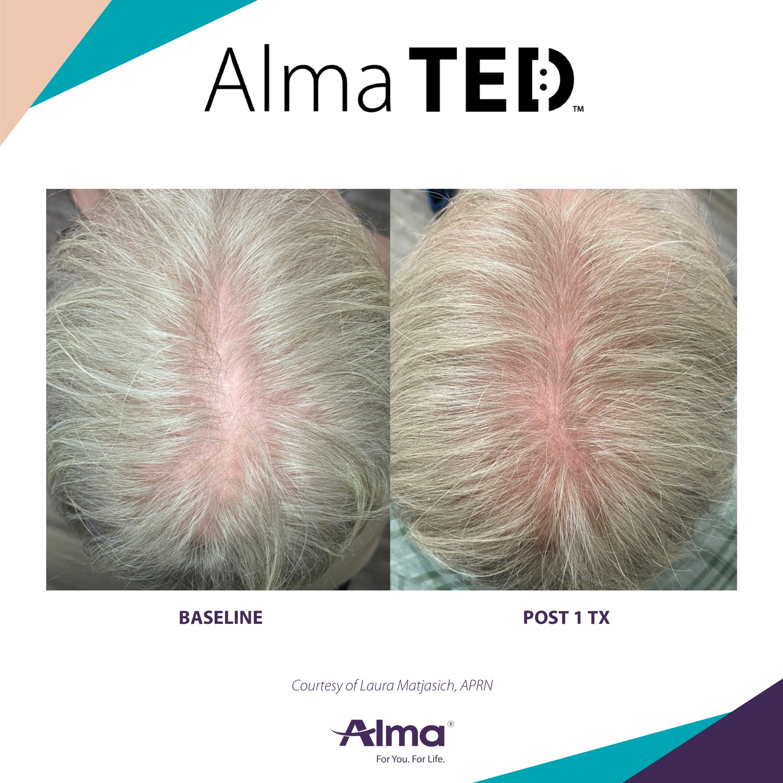 Before and After Image: Alma TED - front
