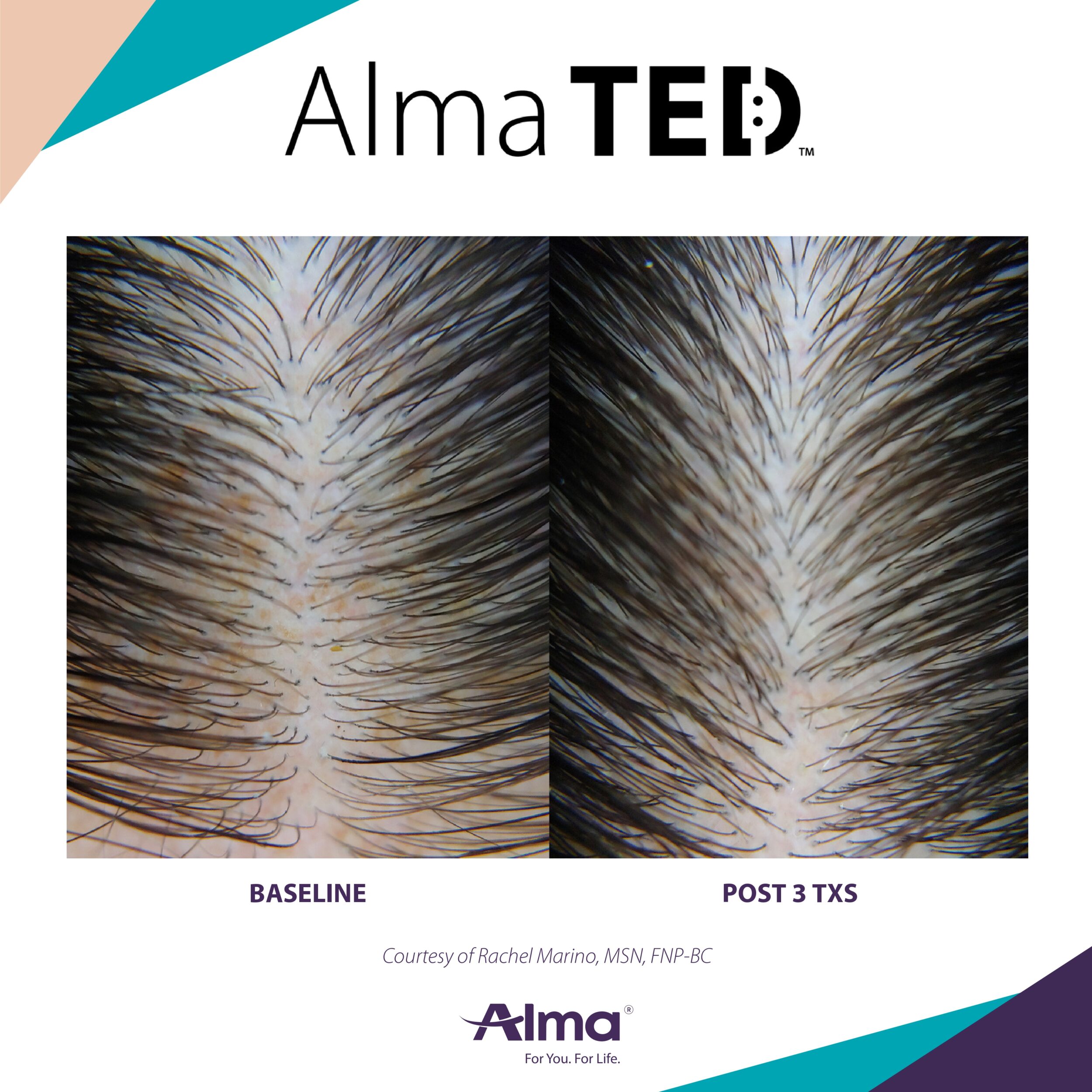 Before and After Image: Alma TED - front