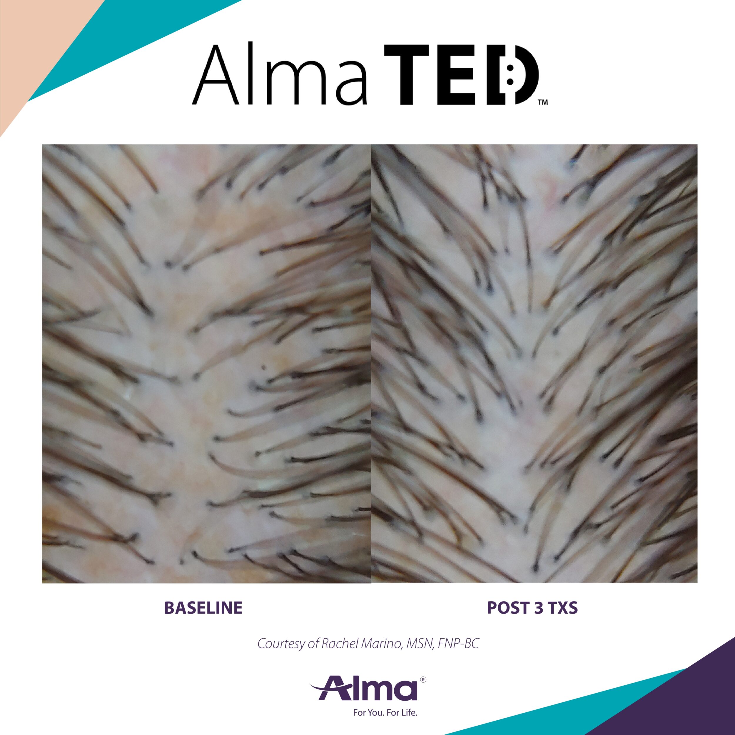 Before and After Image: Alma TED - front