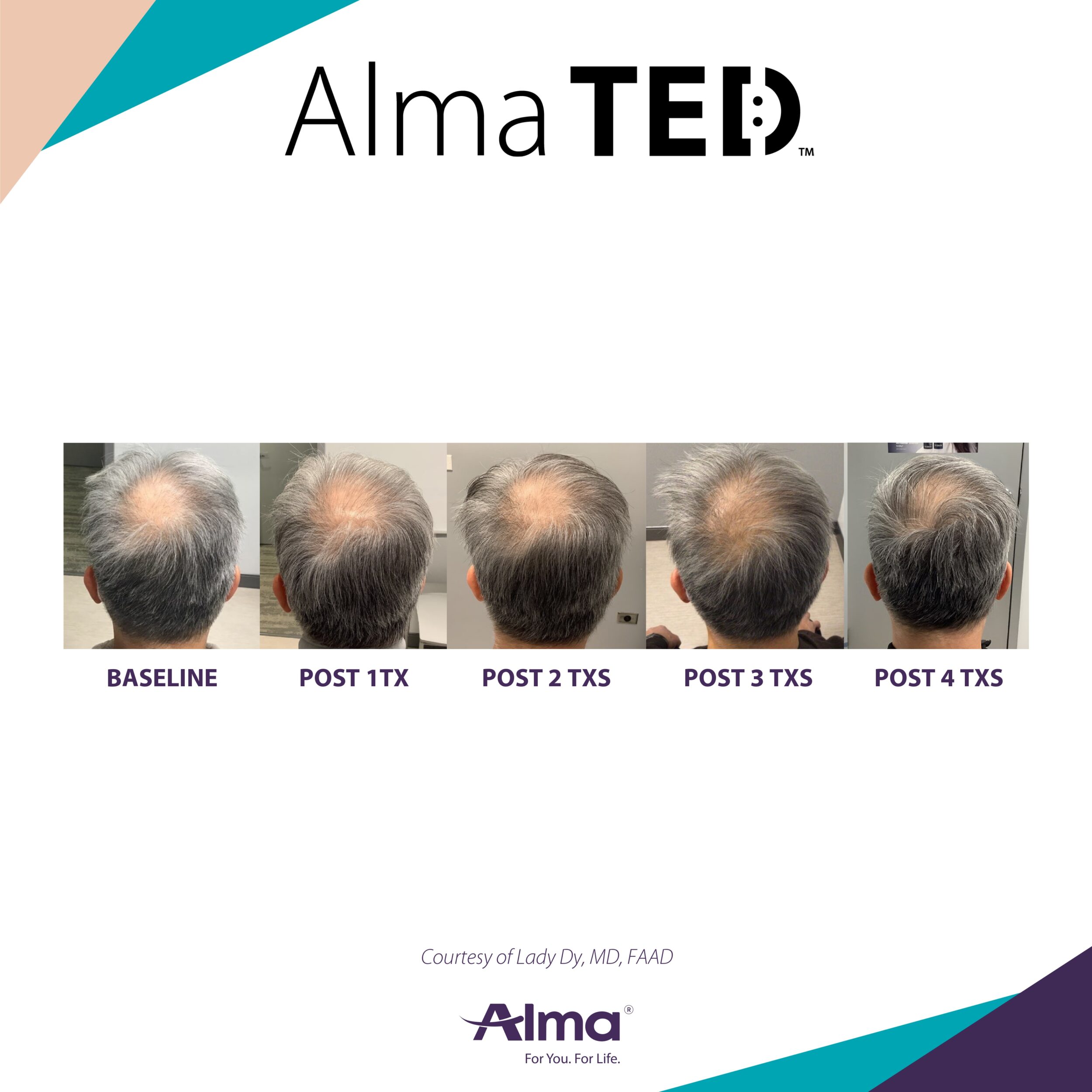 Before and After Image: Alma TED - back